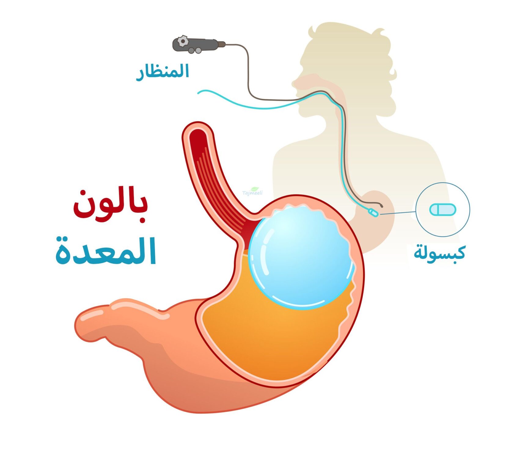 كبسولة المعدة بمستشفى الحبيب سعرها كبسولة المعدة بمستشفى الحبيب سعرها