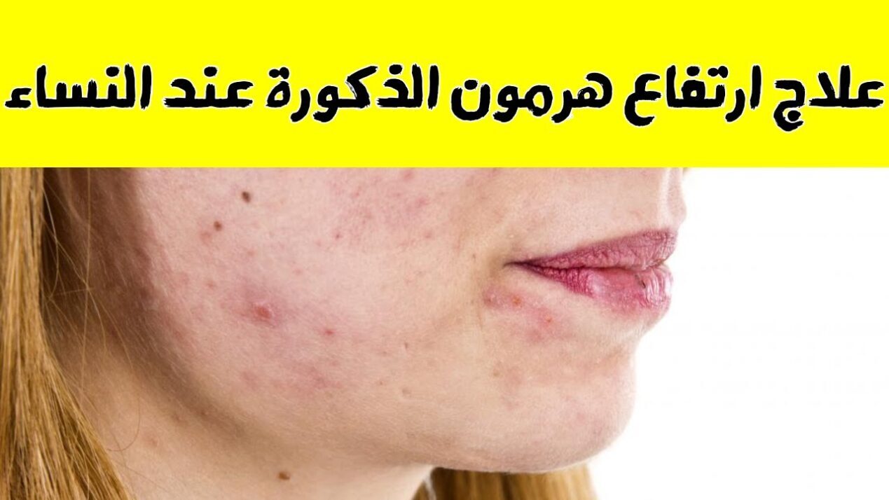 تجربتي في علاج هرمون الذكورة