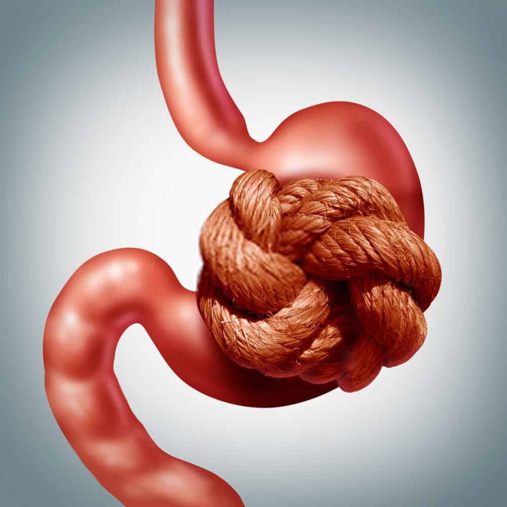 تجربتي مع الدكتور عايض القحطاني كرمشة المعدة والتكميم