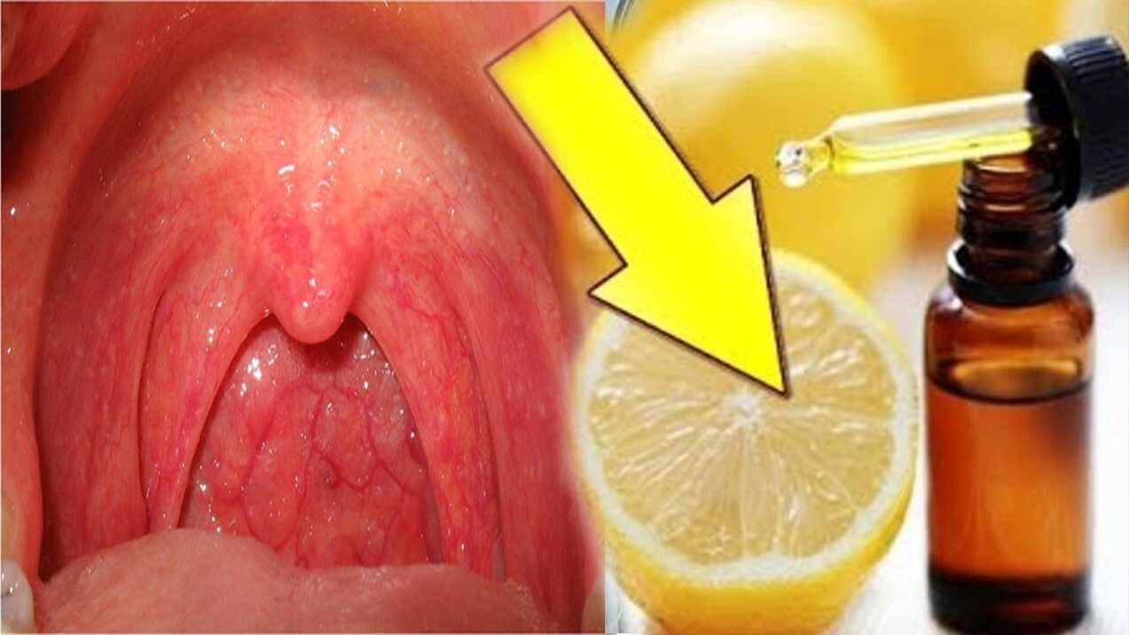 علاج التهاب الحلق للحامل عالم حواء