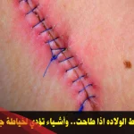 كيف اخلي خيوط الولادة تطيح بسرعه