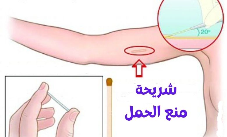 تجربتي مع شريحة منع الحمل تجربتي مع شريحة منع الحمل
