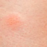 نقط حمراء صغيرة جدا على الجلد عالم حواء
