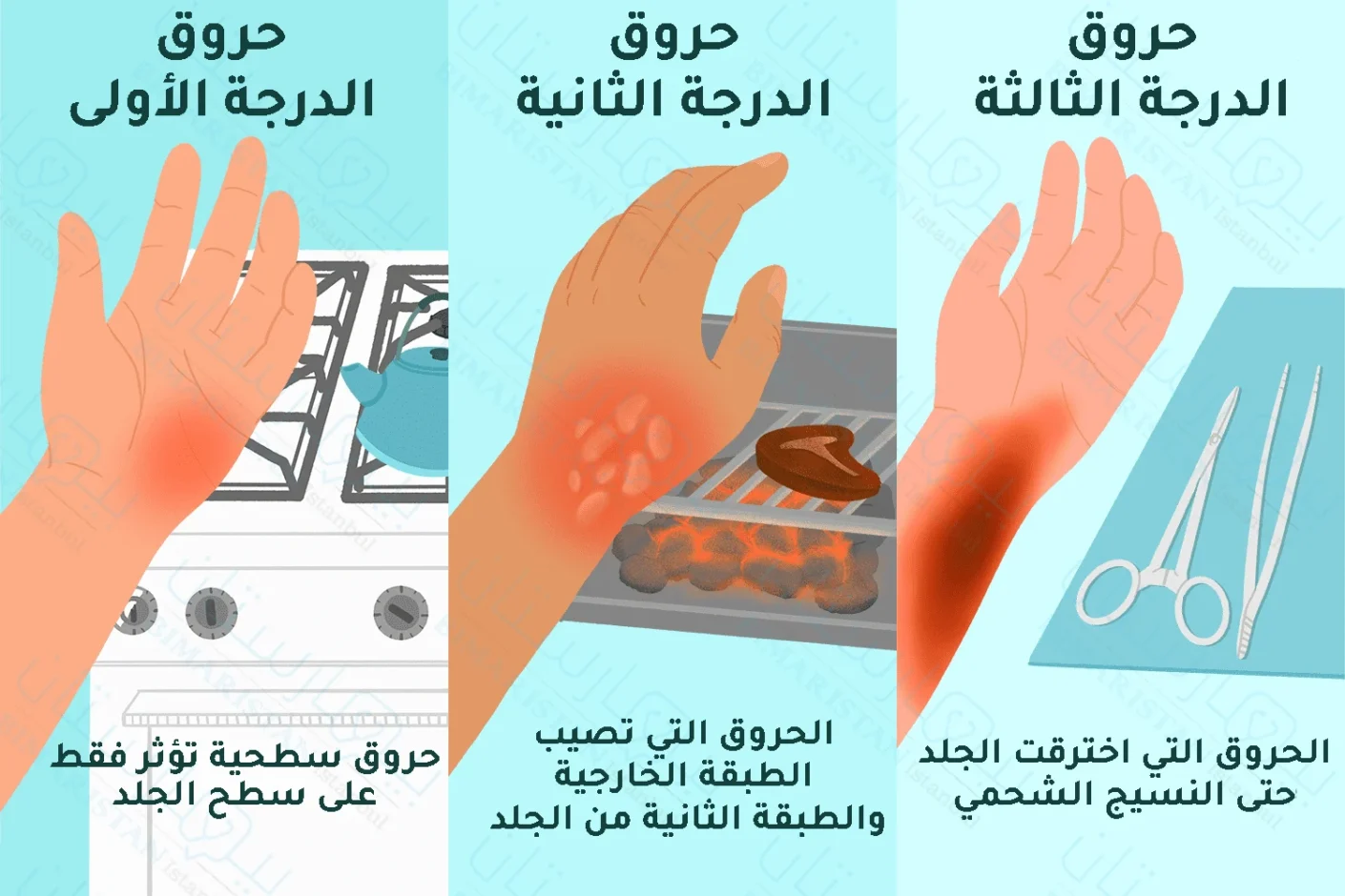 دواعي استخدام كريم سيني ميب بلس للحروق دواعي استخدام كريم سيني ميب بلس للحروق