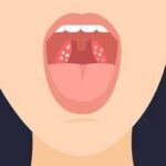 تجربتي مع حصوات اللوز الأسباب والأعراض وطرق علاجها