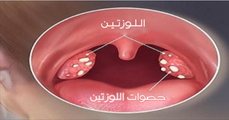 تجربتي مع حصوات اللوز الأسباب والأعراض وطرق علاجها