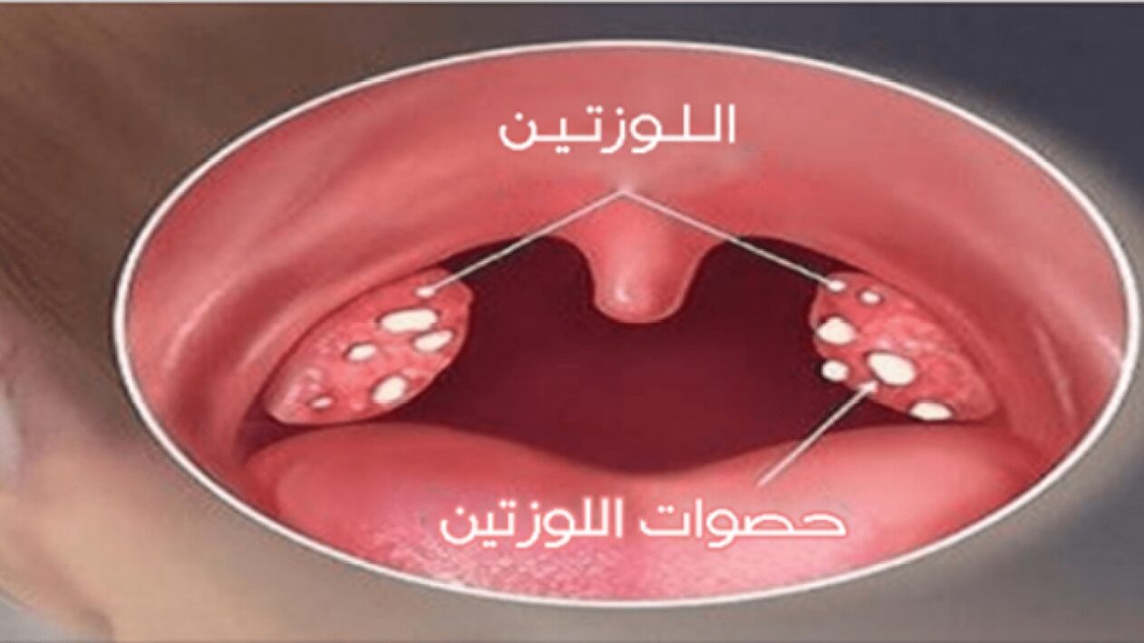 تجربتي مع حصوات اللوز الأسباب والأعراض وطرق علاجها