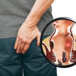 تجربتي مع معاناتي بعد عملية البواسير