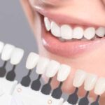كتالوج درجات الوان اسنان الزيركون