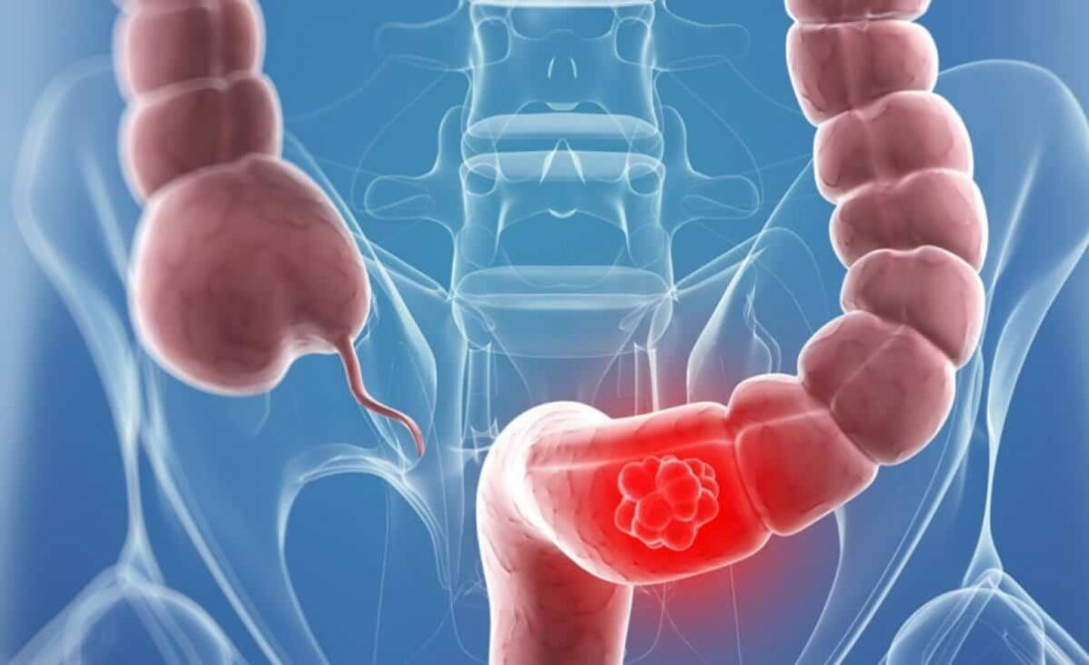 طريقة علاج القولون العصبي النفسي بالقران والأعشاب