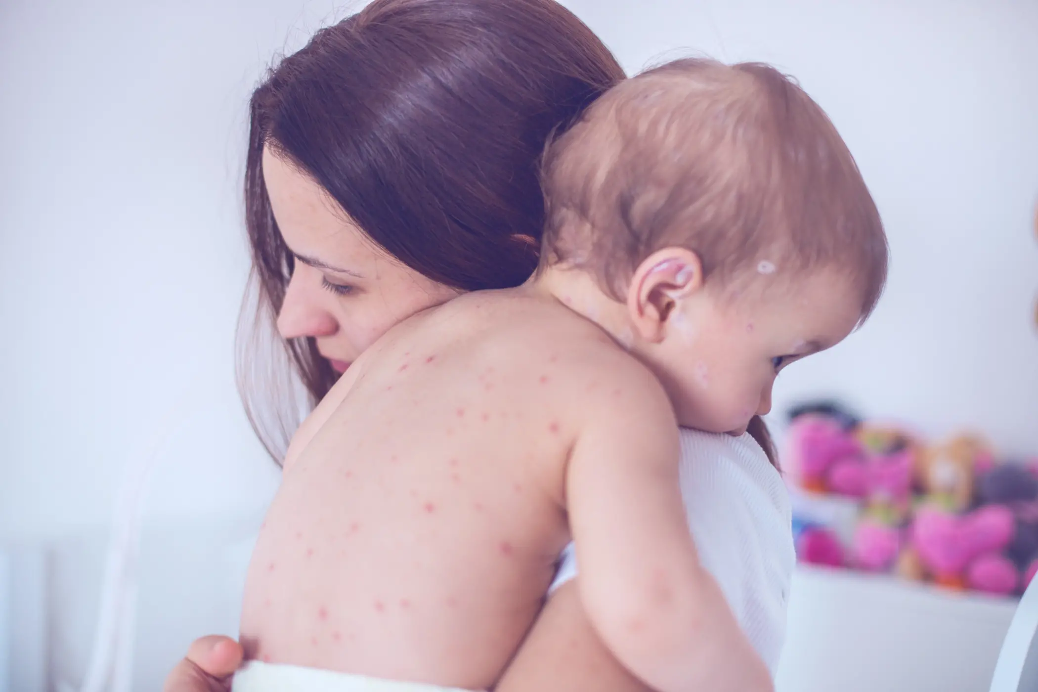 افضل مرهم حساسية للاطفال من الصيدلية