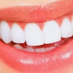 اسعار تلبيس الاسنان في المهيدب