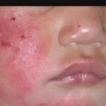 علاج الارتيكاريا بالاعشاب جابر القحطاني