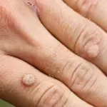 علاج الثالول بالقران