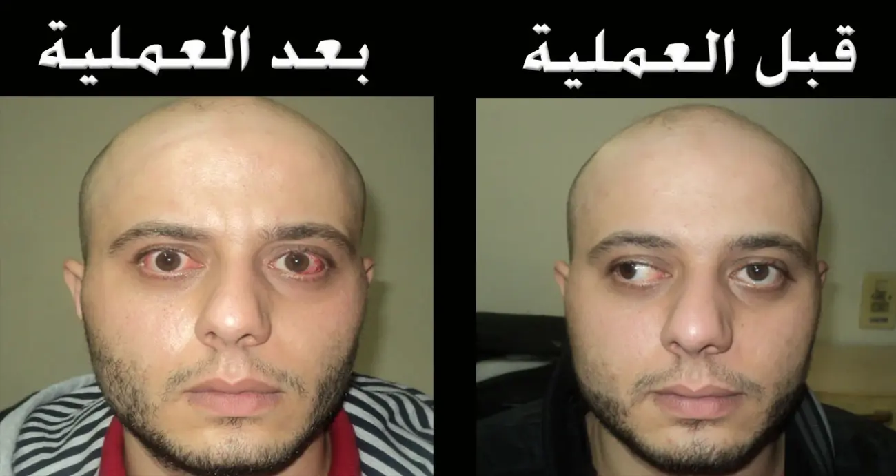 تجربتي مع عملية الحول