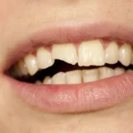 تفسير حلم سن مكسور لابن سيرين وما الدلالات