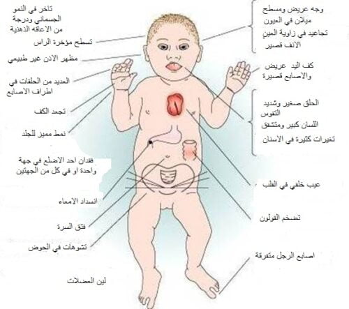 كم وزن الطفل المنغولي عند الولادة
