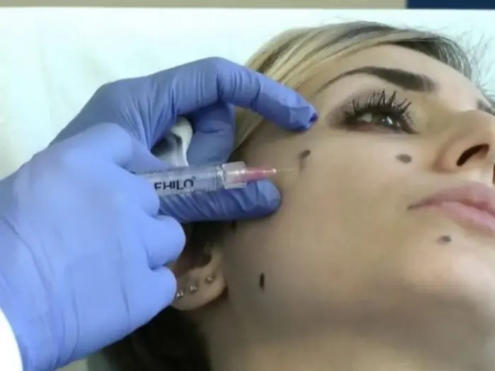 اضرار ابرة بروفايلو