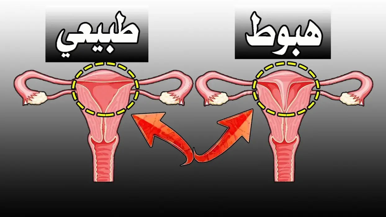 تجاربكم مع عملية رفع الرحم