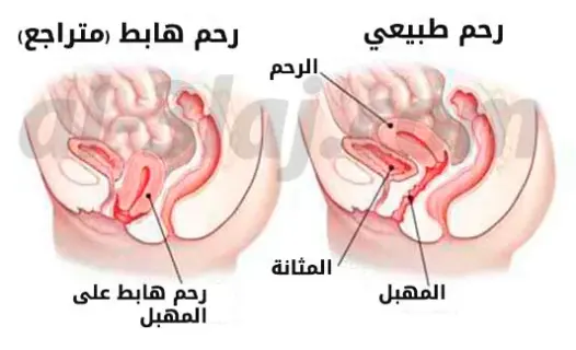 تجاربكم مع عملية رفع الرحم
