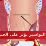 هل البواسير تؤثر على الجنين
