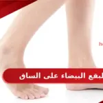اسباب ظهور البقع البيضاء على الساق وطرق علاجها
