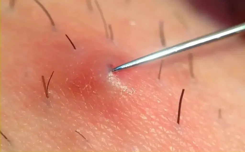 تجربتي في إزالة الشعر تحت الجلد نهائيا