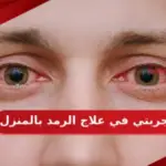 تجربتي في علاج الرمد في المنزل وطرق الوقاية منه