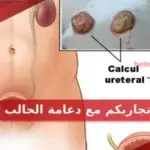 تجاربكم مع دعامة الحالب