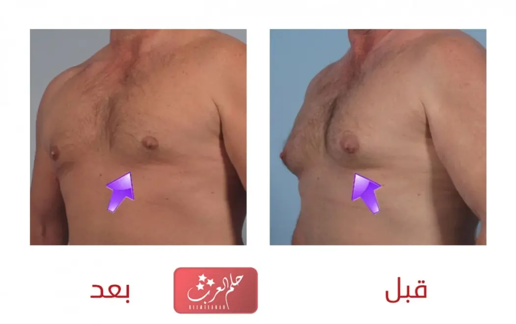 تجربتي مع عملية التثدي