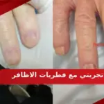تجربتي مع فطريات الاظافر وطرق علاجها في المنزل
