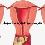 تجربتي مع فطريات المهبل