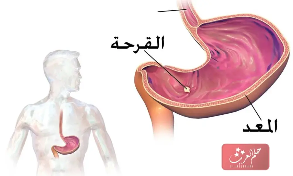 تجربتي مع قرحة الاثني عشر وطرق الوقاية منها