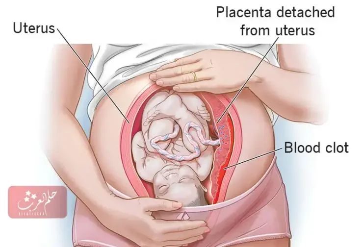 هل التجمع الدموي يوقف نبض الجنين ومتى يختفي التجمع من الرحم