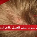هل يموت بيض القمل بالحرارة