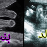 الفرق بين سونار البنت والولد في الشهر الثالث
