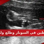 خطين في السونار وطلع ولد