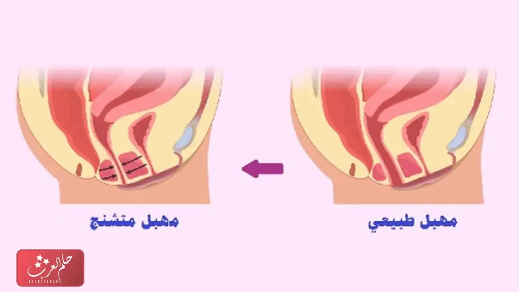 علاج التشنج المهبلي بالقران واسباب ظهوره