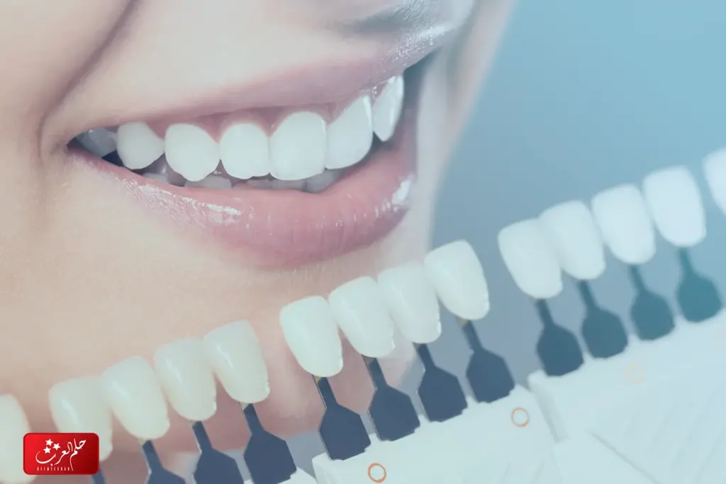 تجربتي مع الفينير المتحرك في تجميل الاسنان
