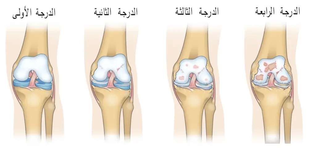 علاج احتكاك الركبة بالطب النبوي