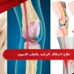 علاج احتكاك الركبة بالطب النبوي