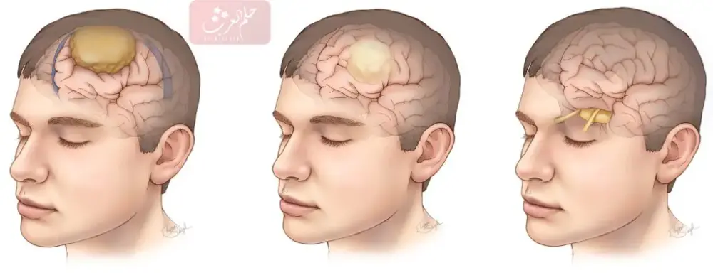 تجربتي مع ورم الدماغ وكم نسبة الشفاء منه