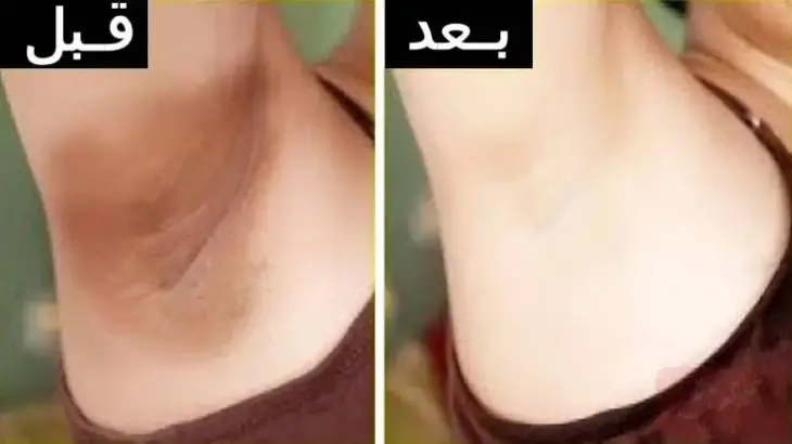 تفتيح المناطق الحساسة بالليزر تجربتي الناجحة