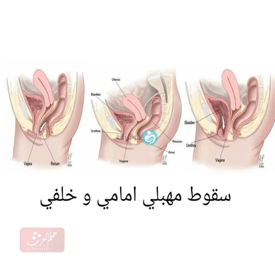 تجربتي مع هبوط المهبل وكيفية علاجه في المنزل