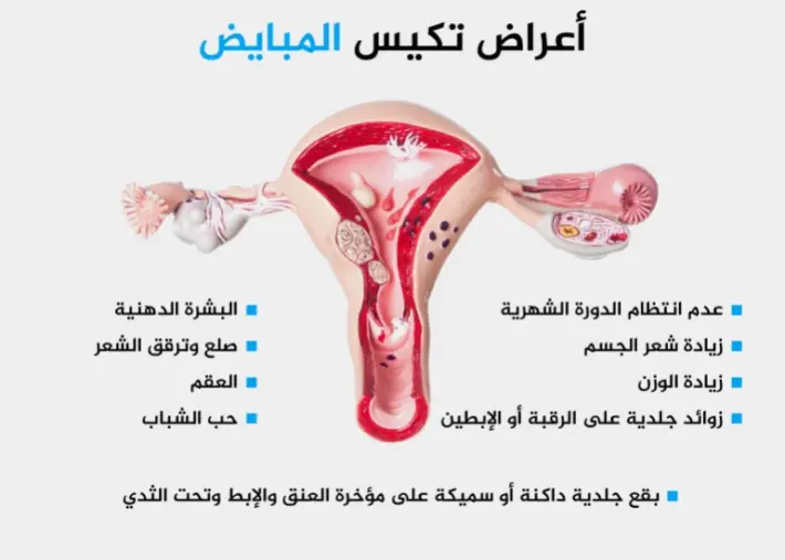 كيف اعرف ان تكيس المبايض راح 
