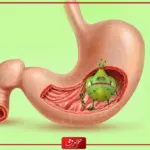 الحمدلله شفيت من جرثومة المعدة .. حالات شفيت من الجرثومه بوقت قصير