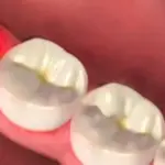 ظهور طبقة بيضاء على اللثة بعد خلع الضرس الأسباب وطرق العلاج