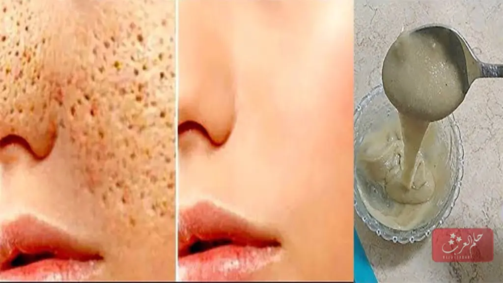 تصغير مسامات الوجه تجربتي الناجحة