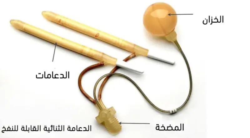 تجربتي مع الدعامه الذكريه العيوب والمميزات ونسبة النجاح