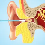 تجربتي مع انسداد قناة استاكيوس مخاطرها وطريقة علاجها